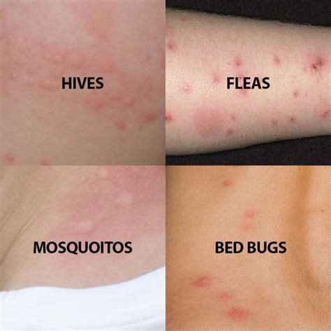 what are similar to bed bug bites